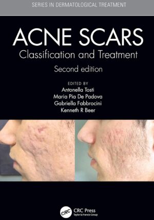 Acne Scars: Classification and Treatment, Second Edition (Series in Dermatological Treatment) 2nd Edition, Kindle Edition