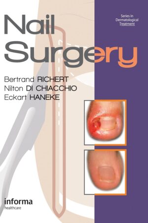 Nail Surgery (Series in Dermatological Treatment) 1st Edition, Kindle Edition